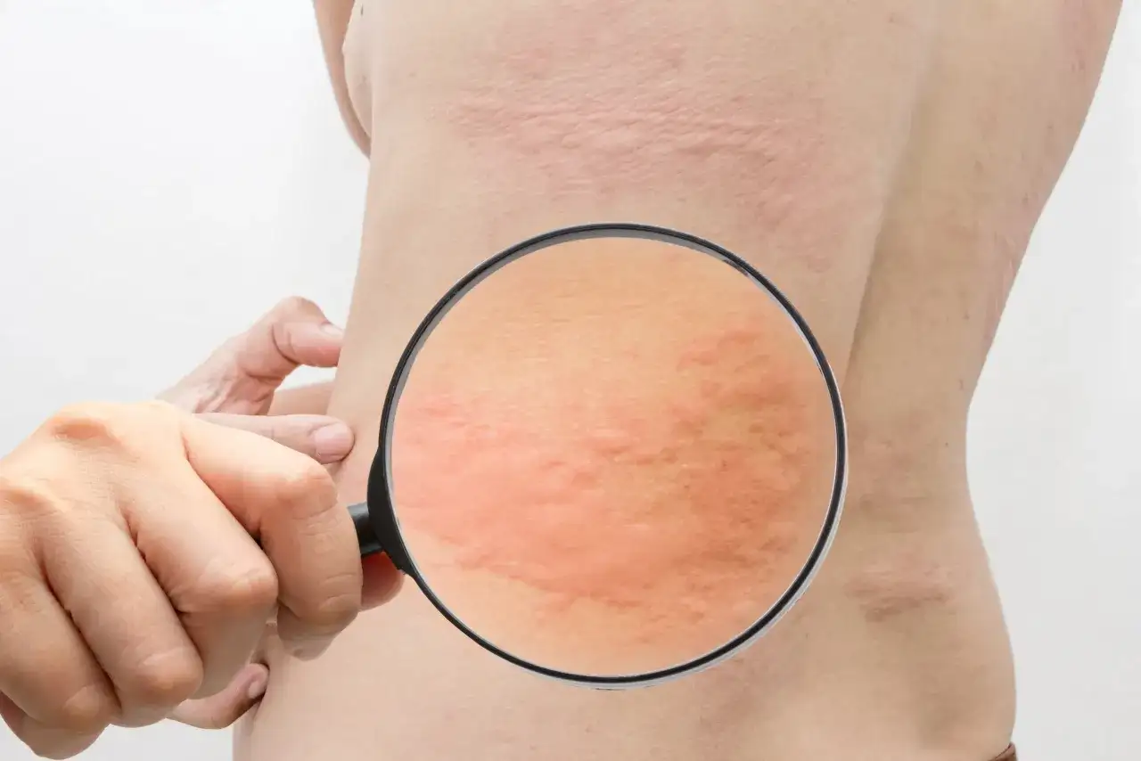 Pokrzywka alergiczna - jak ją rozpoznać i kiedy reagować?