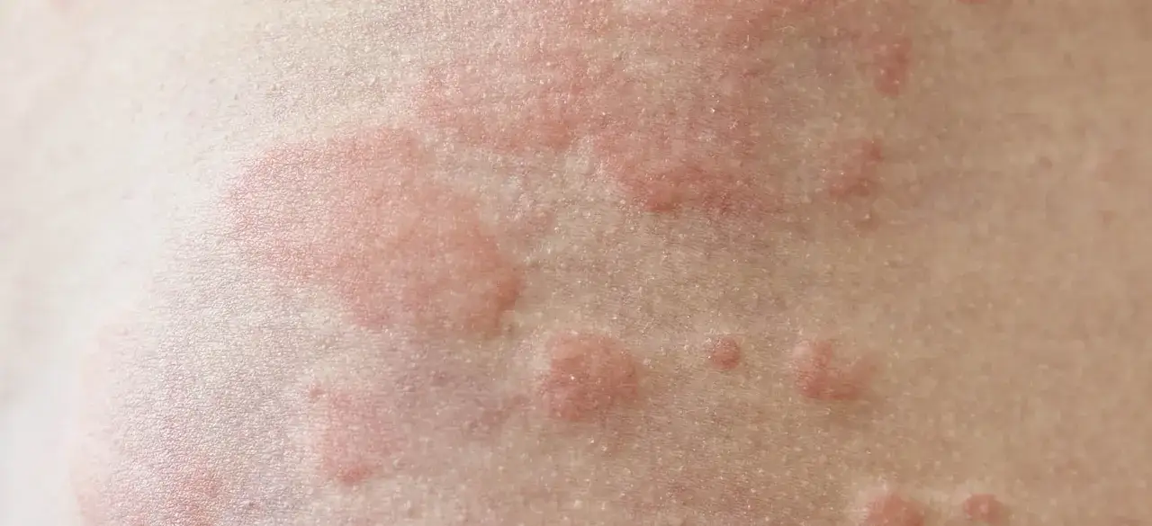 Skóra z czerwonymi, swędzącymi bąblami, objawami pokrzywki alergicznej.